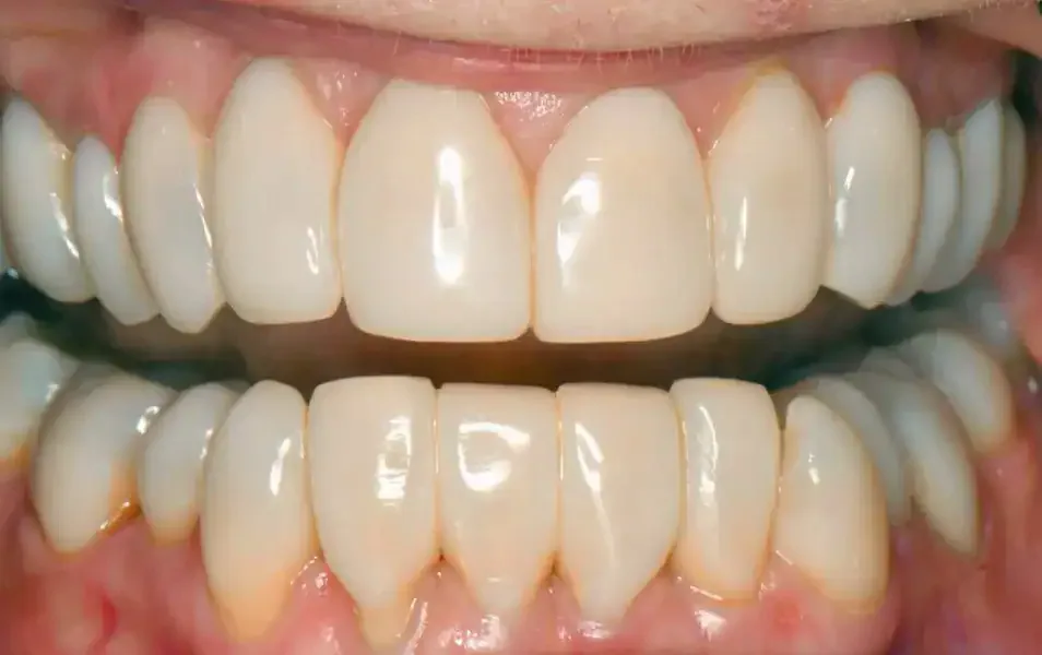 A finished porcelain veneer case at Westlake Dental Care, upper and lower