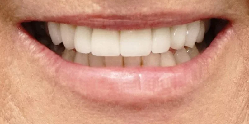 Full-arch transformation — after