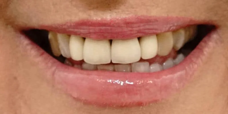 Full-arch transformation — before