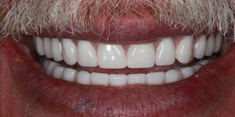 Full-mouth rehabilitation — after