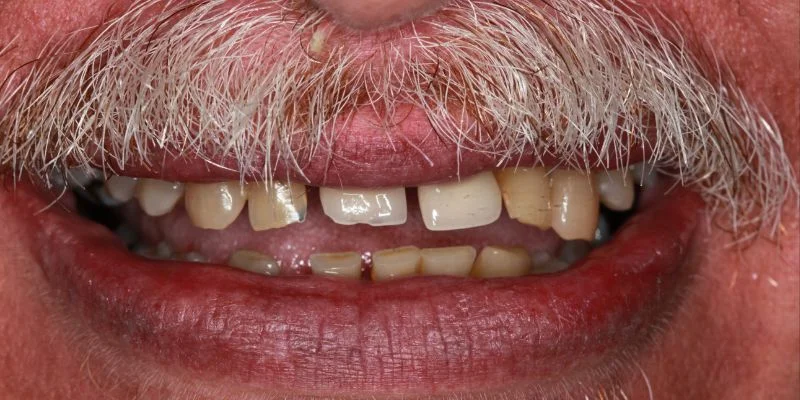 Full-mouth rehabilitation — before