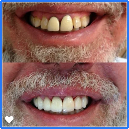 A Westlake Dental Care veneers case, before and after, side by side